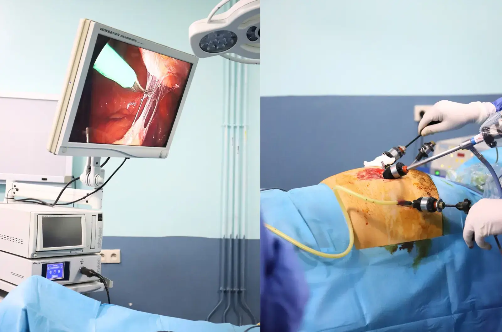 Cure de hernie par laparoscopie à la Clinique Achifaa Oujda