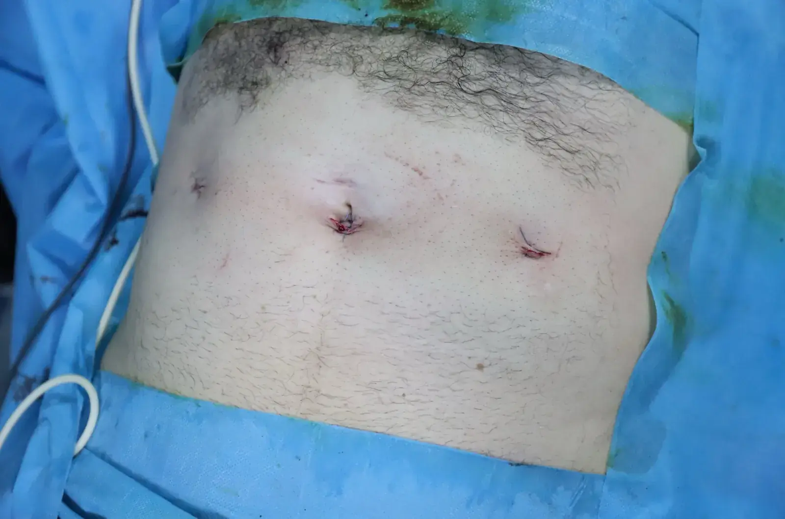 Résultat des petites incisions après cure de hernie par laparoscopie