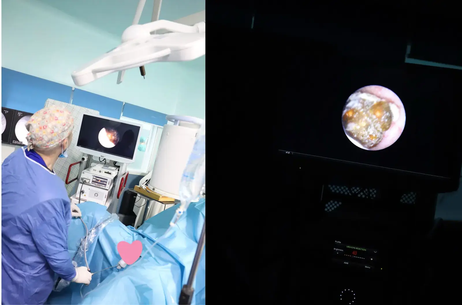 Visualisation endoscopique pendant une urétéroscopie laser