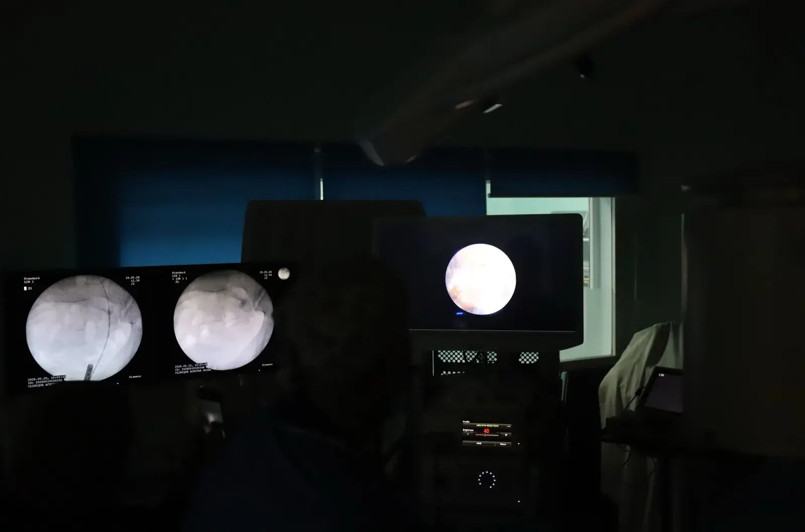 Écrans de contrôle pendant une urétéroscopie laser Thulium
